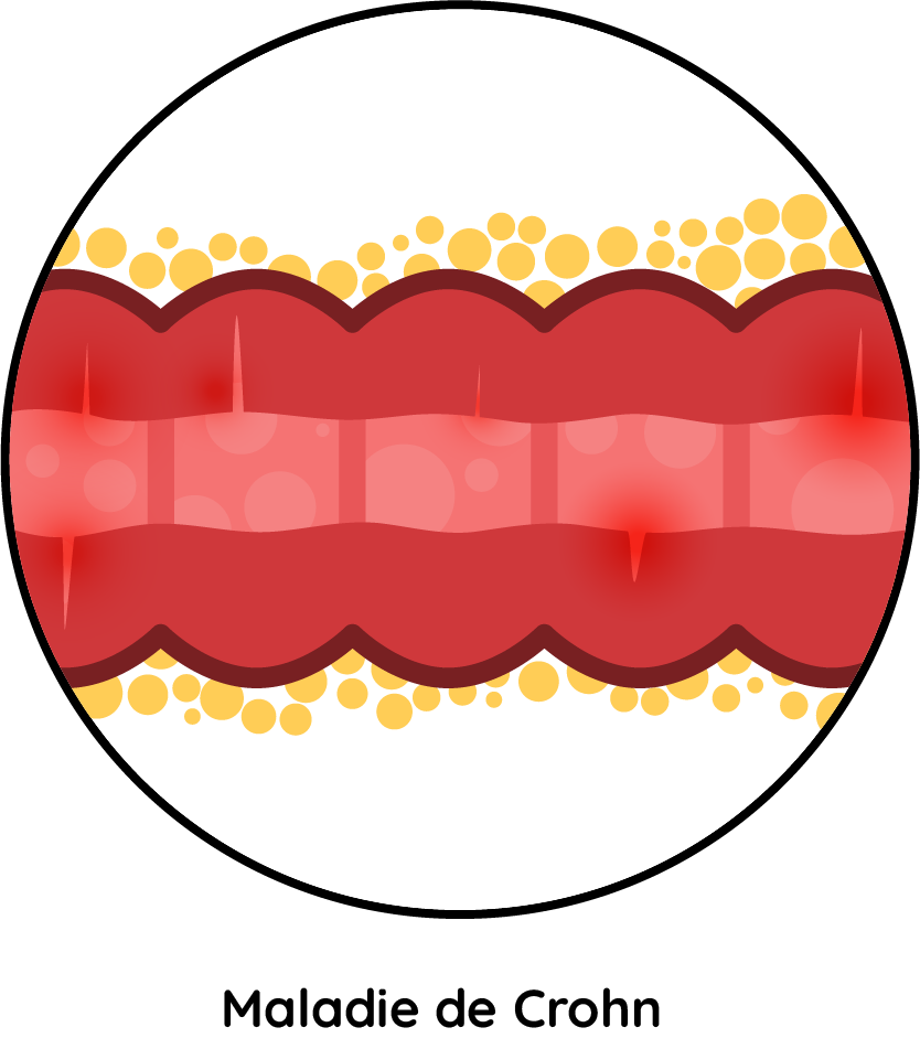 Maladie de Crohn Maladie de Crohn